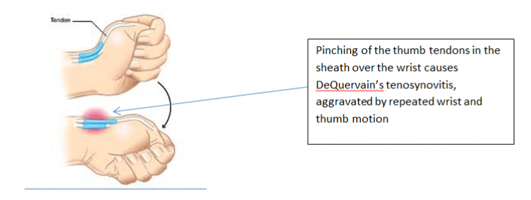 Dequervains Tenosynovitis Hand Surgery Associates