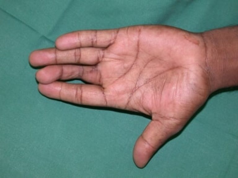 types-of-finger-deformities