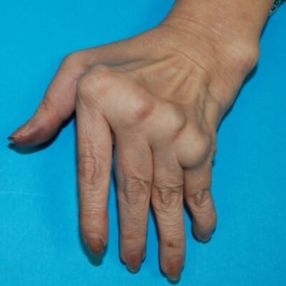 deformitas-tangan-hand-surgery-associates