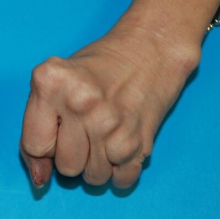 Deformities of the Hand | Hand Surgery Associates