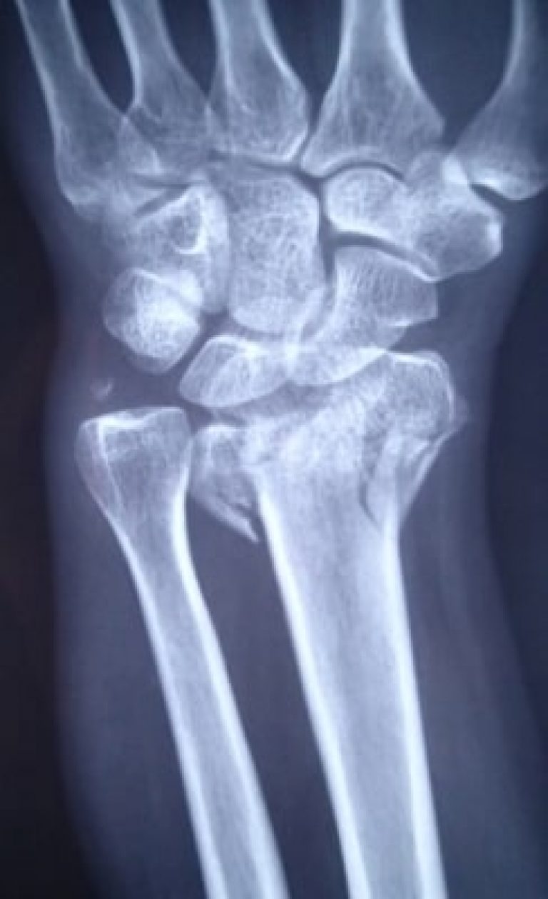 using a tuning fork for fractures