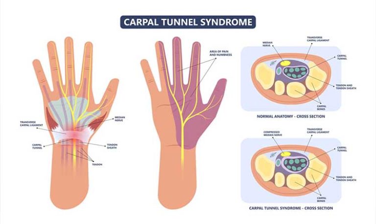 Carpal Tunnel Syndrome Treatment & Surgery in SG | HSA